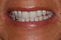 Life Like Cosmetic Denture after