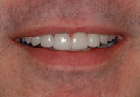 Stained Teeth After