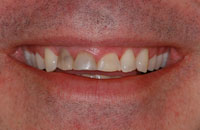 Stained Teeth Before
