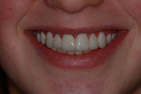 Prepless Veneers after