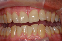 Crooked Teeth before