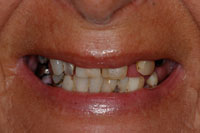 Life Like Cosmetic Denture before