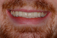 Large Cavities in Front Teeth After